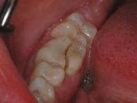 Non restorable lower molar